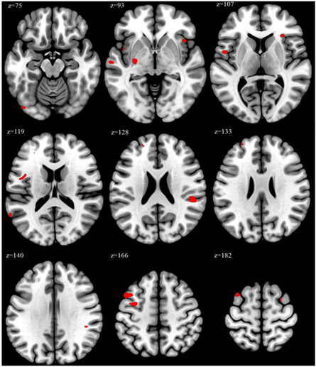 Results of voxel-based morphometry (VBM) analysis showing significant voxels for the contrast between overworked and non-overworked groups. Peak VBM values in the overwork group were significantly higher than those in the non-overwork group in the indicated brain regions (red areas, p<0.05, family-wise error corrected).